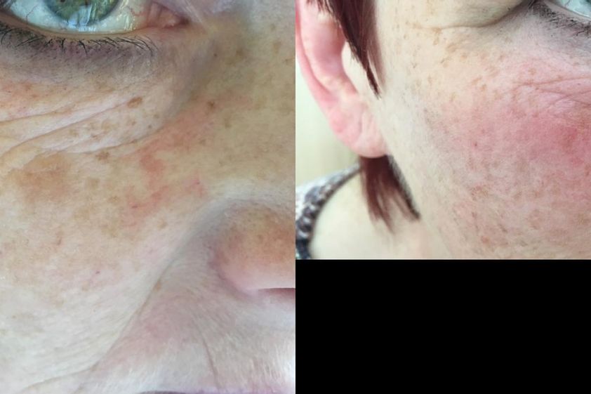 Laserová dermatologie před a po - 728627