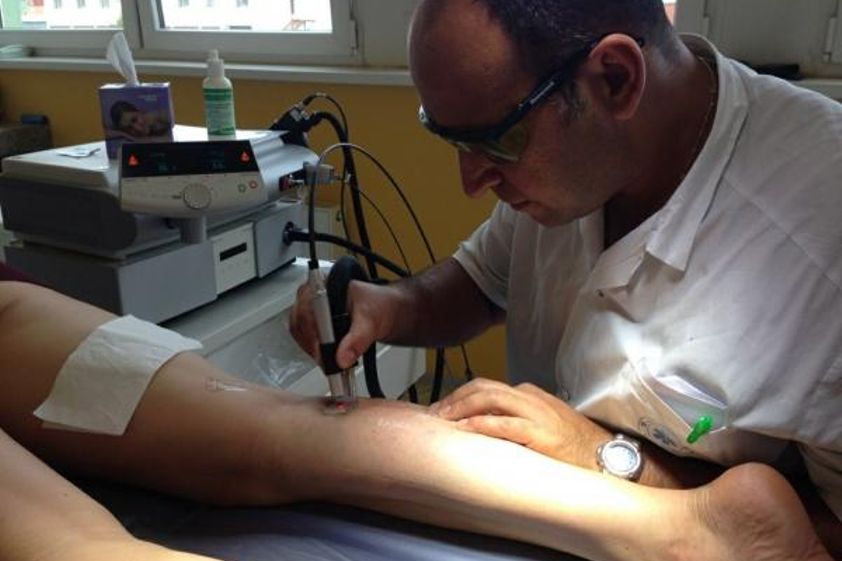 Laserové odstranění rozšířených žilek před a po - 728632