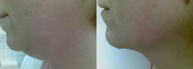 lipolyza 1 pred