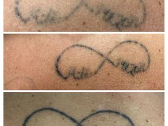 Odstranění tetování - 837445