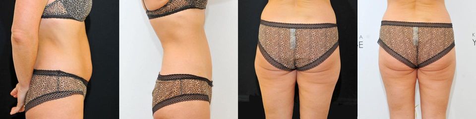 Laserová liposukce + kryolipolýza