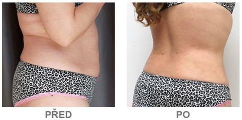 slimlipo2