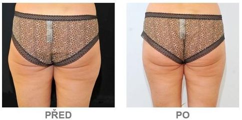 slimlipo3