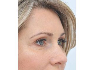 Operace očních víček - Klinika YES VISAGE