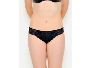 Abdominoplastika - Klinika YES VISAGE