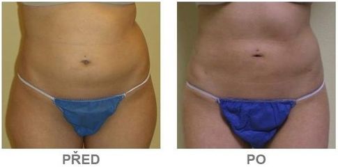 slimlipo5