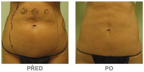 slimlipo6