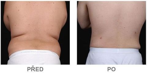 slimlipo7