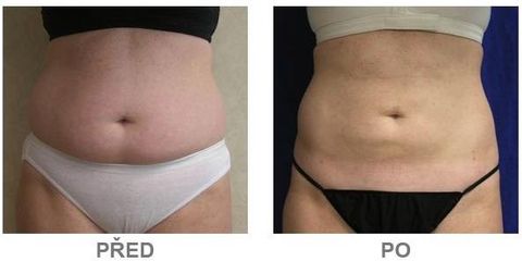slimlipo8