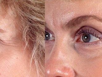 Brow lift před a po - 817962