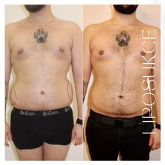 Liposukce - Klinika YES VISAGE