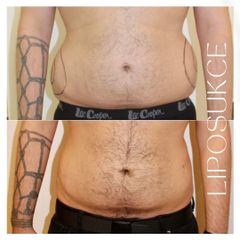 Liposukce - Klinika YES VISAGE