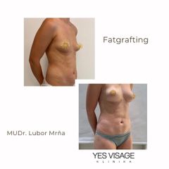 Lipofilling prsou - Klinika YES VISAGE
