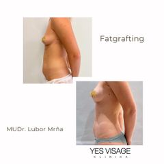 Lipofilling prsou - Klinika YES VISAGE