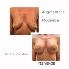 Modelace prsou - Klinika YES VISAGE