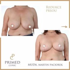 redukce