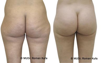 liposukce1 pred