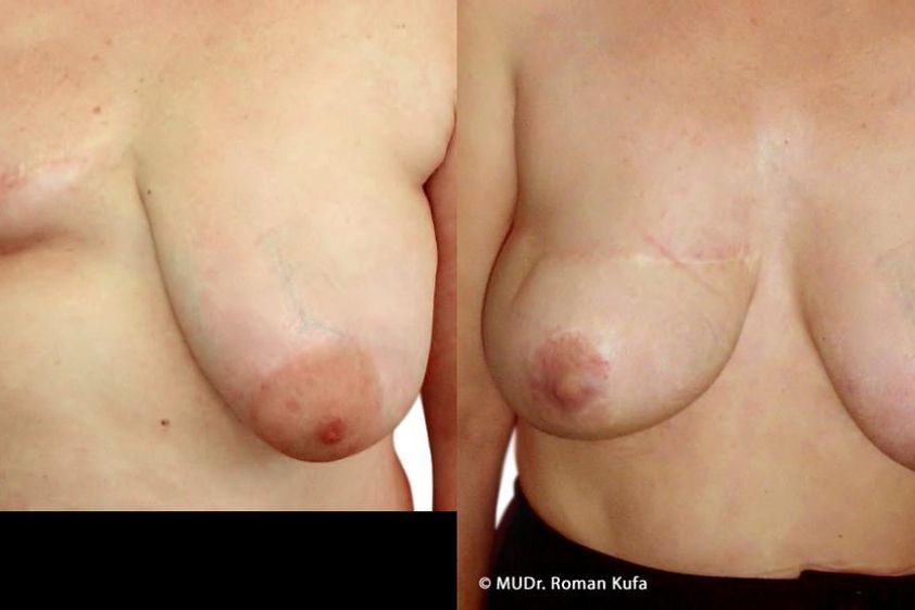 Rekonstrukce prsu před a po - 714753