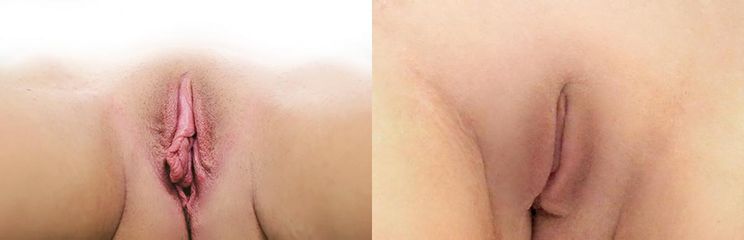 labia pred