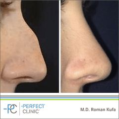 Plastika nosu (Rhinoplastika) - MUDr. Roman Kufa - Perfect Clinic
