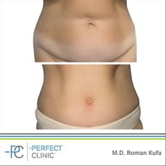 Abdominoplastika (Operace břicha) - MUDr. Roman Kufa - Perfect Clinic
