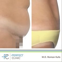 Abdominoplastika (Operace břicha) - MUDr. Roman Kufa - Perfect Clinic
