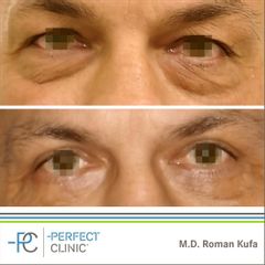 Operace očních víček (Blefaroplastika) - MUDr. Roman Kufa - Perfect Clinic