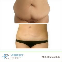 Abdominoplastika (Operace břicha) - MUDr. Roman Kufa - Perfect Clinic