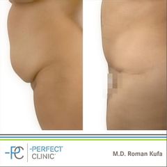 Abdominoplastika (Operace břicha) - MUDr. Roman Kufa - Perfect Clinic