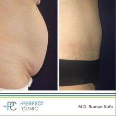 Abdominoplastika (Operace břicha) - MUDr. Roman Kufa - Perfect Clinic