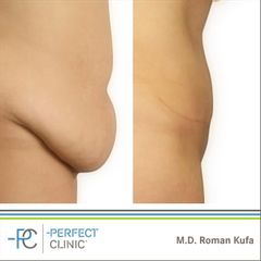 Abdominoplastika (Operace břicha) - MUDr. Roman Kufa - Perfect Clinic