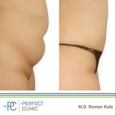 Abdominoplastika (Operace břicha) - MUDr. Roman Kufa - Perfect Clinic