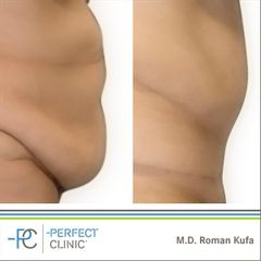 Abdominoplastika (Operace břicha) - MUDr. Roman Kufa - Perfect Clinic