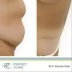Abdominoplastika (Operace břicha) - MUDr. Roman Kufa - Perfect Clinic