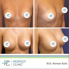 Zvětšení prsou (Augmentace) - MUDr. Roman Kufa - Perfect Clinic