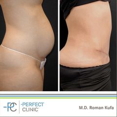 Abdominoplastika - MUDr. Roman Kufa - Perfect Clinic