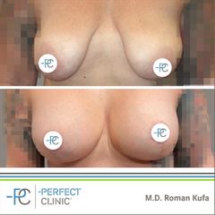 Zvětšení prsou - MUDr. Roman Kufa