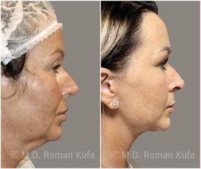 Facelift  - MUDr. Roman Kufa - Perfect Clinic