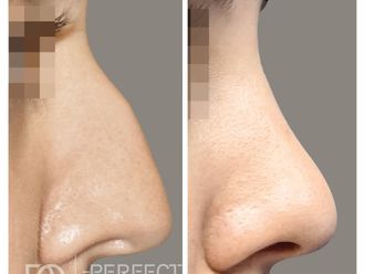 Rhinoplastika - 794222