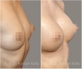 Zvětšení prsou - MUDr. Roman Kufa - Perfect Clinic