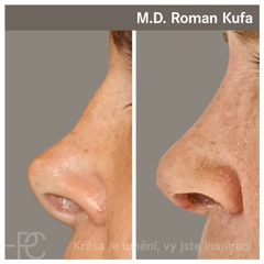 Rhinoplastika - MUDr. Roman Kufa - Perfect Clinic