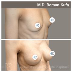 Zvětšení prsou - MUDr. Roman Kufa - Perfect Clinic