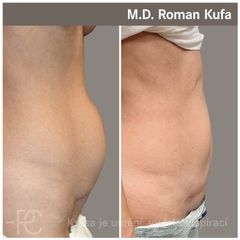Abdominoplastika - MUDr. Roman Kufa - Perfect Clinic