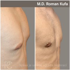Gynekomastie - MUDr. Roman Kufa - Perfect Clinic