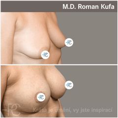 Zvětšení prsou - MUDr. Roman Kufa - Perfect Clinic