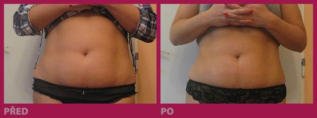 lipo01