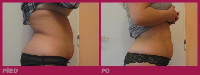 lipo02
