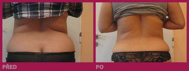 lipo03