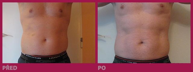 lipo04