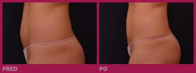 lipo05